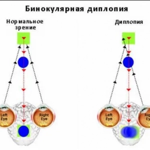 Двоїться в одному оці (монокулярна диплопія): причини і методи лікування
