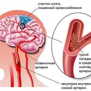 Перша допомога при інсульті до приїзду швидкої: що робити в домашніх умовах