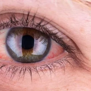Причина червоних очей у дорослого і методи лікування. Травмування і захворювання очей