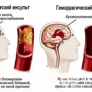 Скільки лежать в лікарні з інсультом? Лікування та особливості відновного періоду